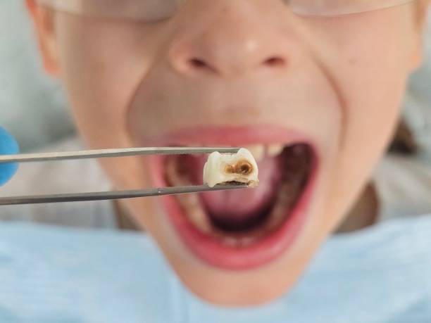 Best Emergency Treatment for Toothache in Vernonia, OR
